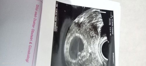 Bun apa mungkin dr. Spog asal ngukur crl? Soalnya titiknya ga sesuai, maaf kalo aneh