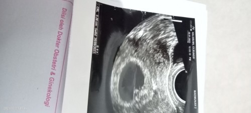 Bun apa mungkin dr. Spog asal ngukur crl? Soalnya titiknya ga sesuai, maaf kalo aneh