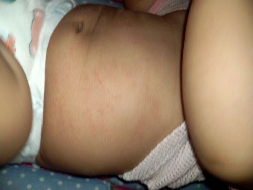 Cara hilangkan ruam pada perut