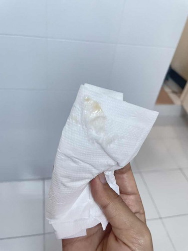 ตกขาวผิดปกติระหว่างตั้งครรภ์