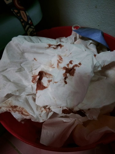 เลือดออกทางช่องคลอด