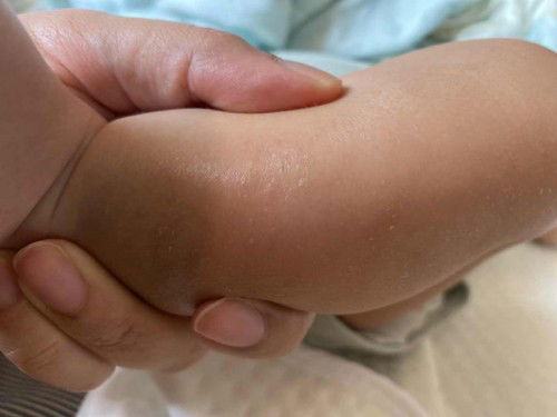 ผิวหนังลูกเป็นแบบนี้คือแพ้อะไรหรอคะ