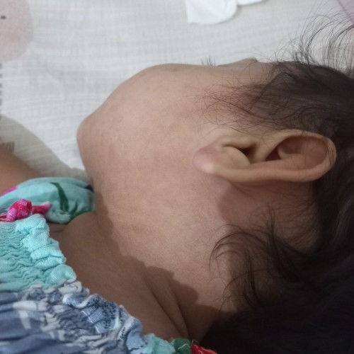 Muka dan leher ruam merah setelah demam hilang. Kenapa ya buibu kirakira?