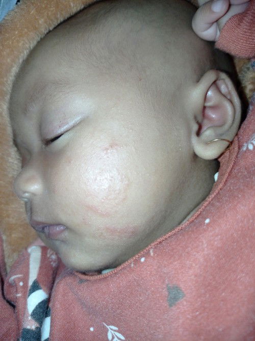 Bintik merah pada wajah