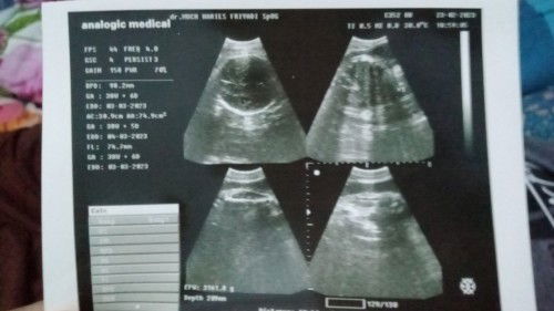 Harus kah lahiran dirumah sakit!?