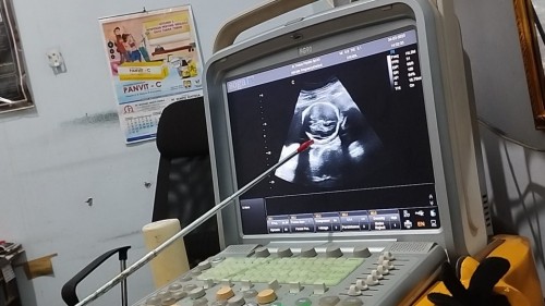 24w kepala janin ada cairan meningitis