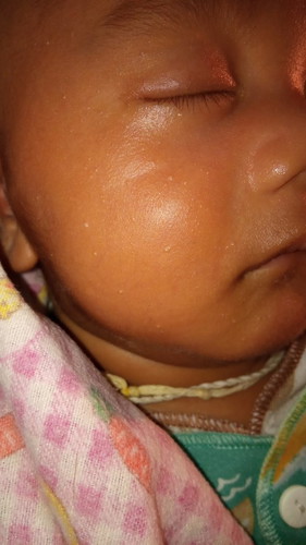 Gimana cara menghilangkan bitik putih pada bayi