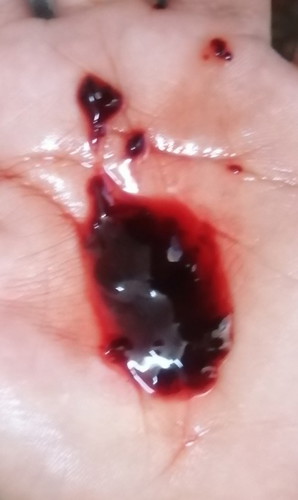 May lumabas po sken ng gnyan?
Kpag umiihi ako bigla nlng gnyan lalabas