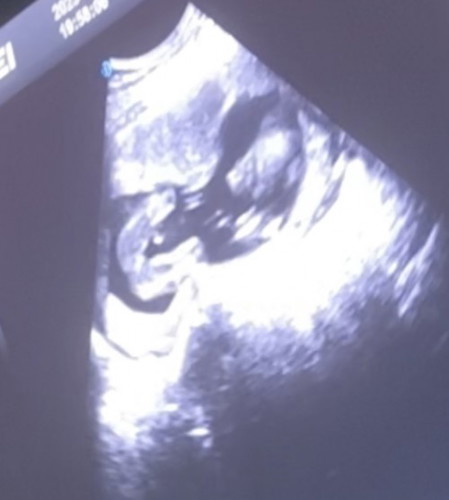 เพศลูก 18 wk