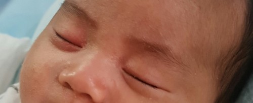 ลูกตาบวมที่เปลือกตา