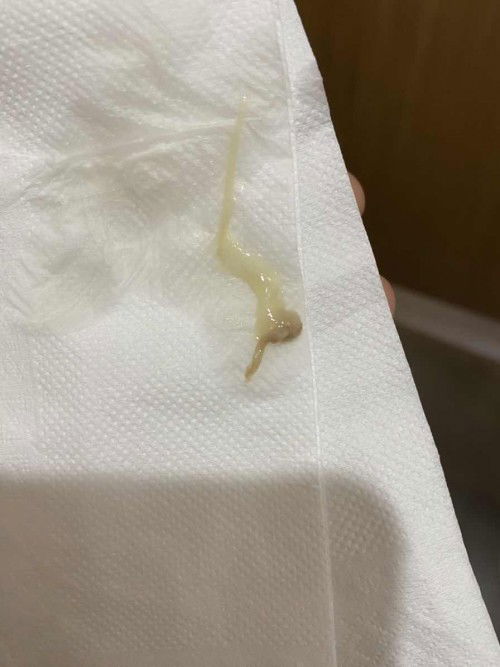 มีตกขาวปนสีน้ำตาลนิดหน่อย