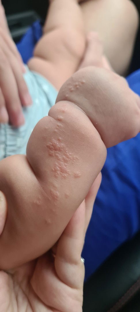 Kulit bentol bayi 6 bln