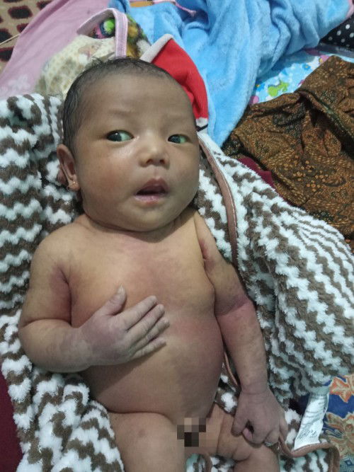 Tentang kulit bayi baru lahir banyak tanda merah ke ungu²an kya gini.