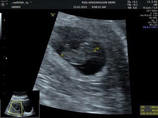 Pendarahan setelah HB