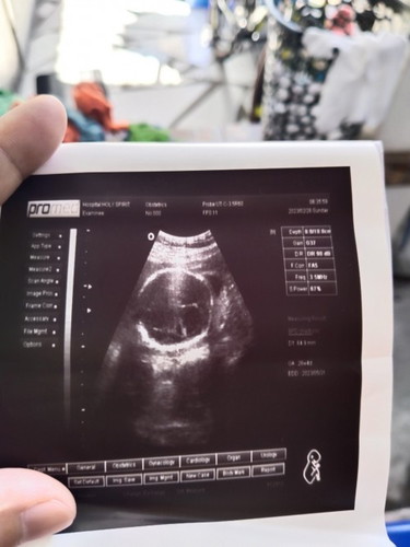MGA Momsh ask Lang Po SA Transvaginal Po ba Malalaman na Na May Hydrocephalus si baby SA Tyan???