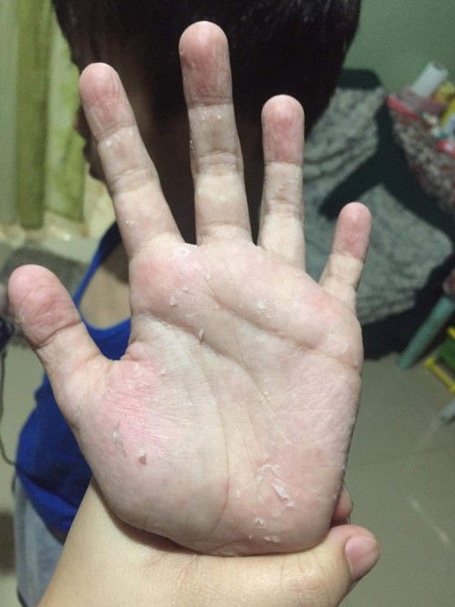 Pagbabalat ng kamay at paa