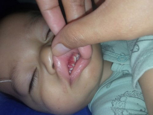 Baby tersadung Dan Luka d gusi