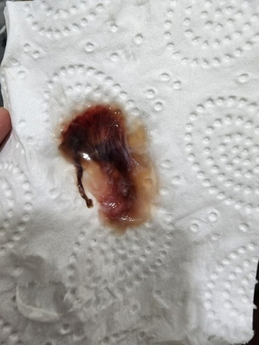 Mucus plug