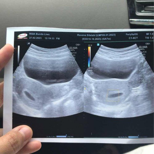 Bentuk kantung kehamilan pipih
