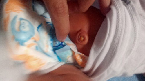 Hi kamommy Ask ko lang kung Normal lang po yan sa pusod ni baby