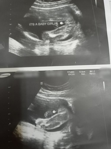 hi po mga ka mommy sure ma po itong ultrasound ko its a girl daw po 22 weeks ako nag pa ultrasound