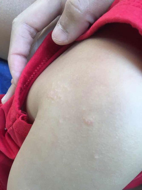 เป็นตุ่มรวมกัน หลายๆจุด