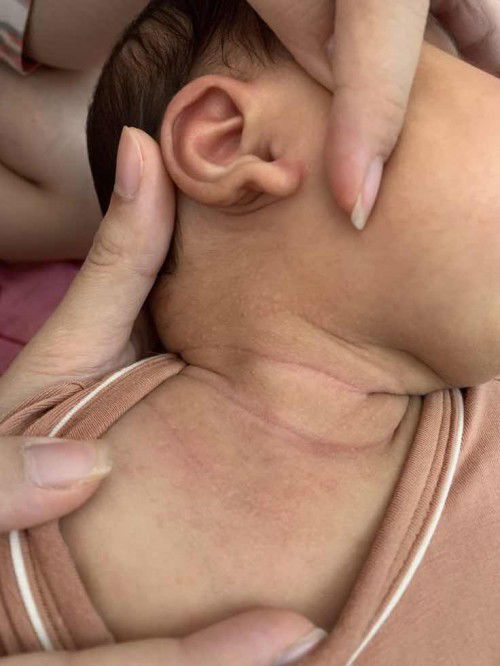 Nổi mẩn nốt màu trắng ở cổ