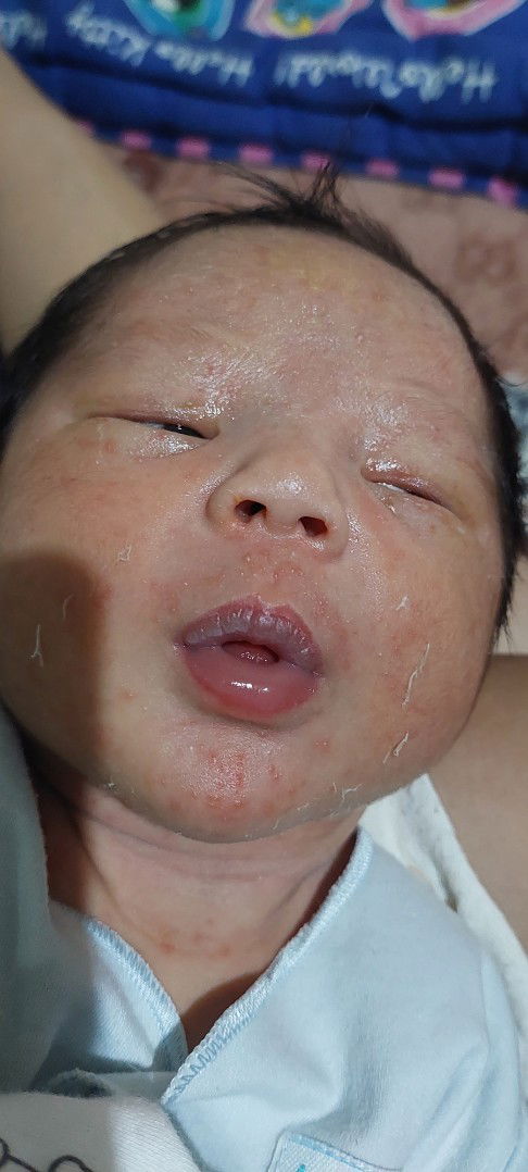 Bruntusan pada wajah