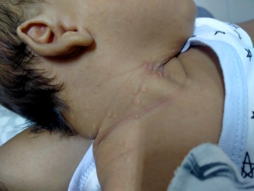 Mga mi ano po kaya cause nito at ano po pwede ilagay?sa leeg ni baby ko po tnx