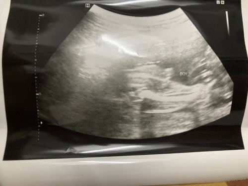 ภาพอัลตราซาวด์