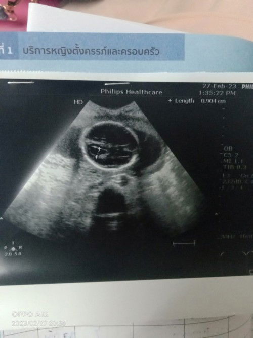 ใครเคยเจอแบบนี้ช่วยแชร์ความรู้หน่อยนะคะ
ช่องว่างในสมองของทารกในครรภ์