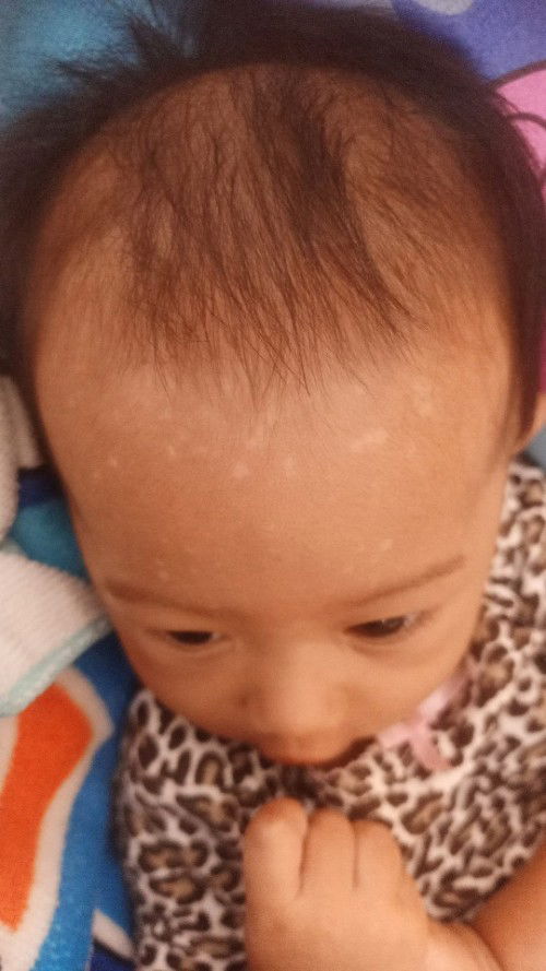 น้องอายุ4เดือนกว่าเป็นกลาบน้ำนม