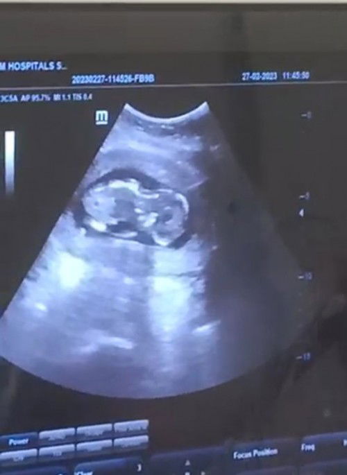 posisi bayi tengkurap kehamilan 13w