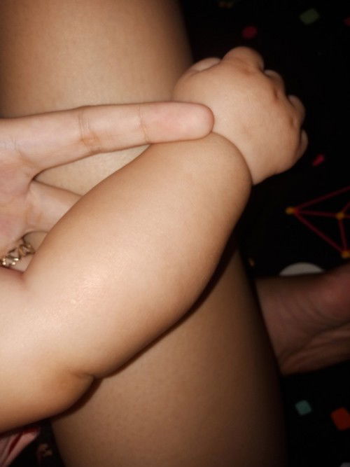 DRY SKIN OR RING WORM