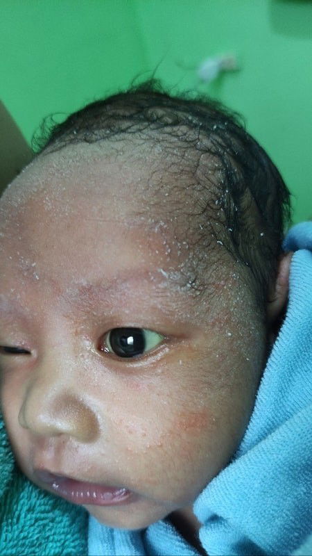 Skin ni baby / baby acne?