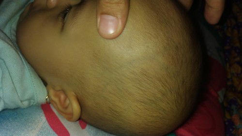 Muncul urat dikepala dan ketika diraba seperti belah