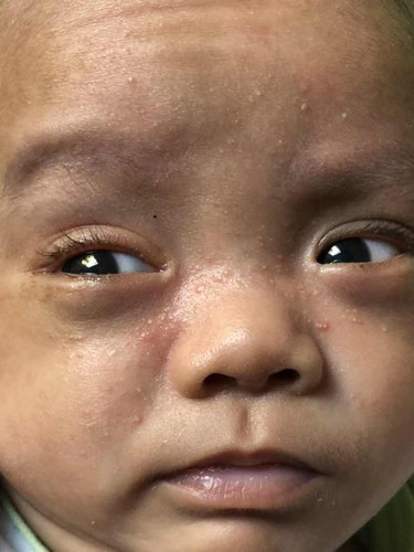 อันนี้ใช่ผดผื่นไหมคะ