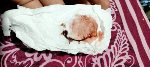 Keluar bercak darah di kehamilan 6 Minggu. Apakah berbahaya,?