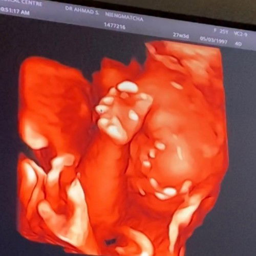 อายุครรภ์ 27 วีค น้องหนัก 1200 กรัม แม่น้ำหนักขึ้นมา 9 โล