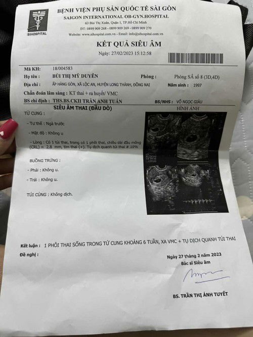 Tụ dịch túi thai 10%