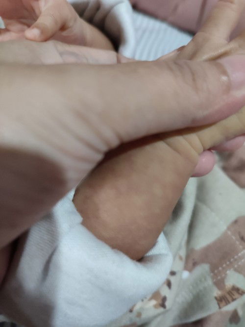 Pembuluh darah bayi pada kulit terlihat jelas