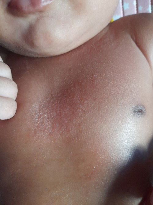 Assalamualaikum bunda2,ada yang anaknya kulitnya sensitif seperti ini gak?kira2 itu kenapa ya bun?1