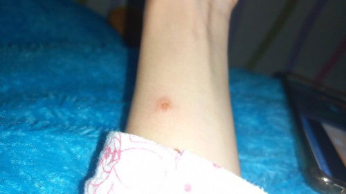 Bintik bintik merah berair dan gatalll