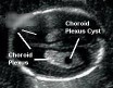 Choroid plexus cyst