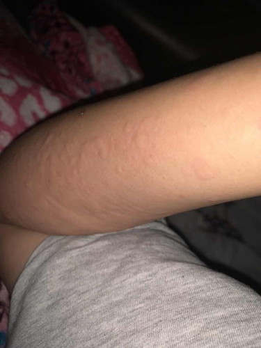 Gatal badan lepas bersalin