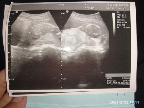 USG 2D pertama kali usia 15minggu