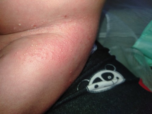 RASHES NI BABY SA PWET