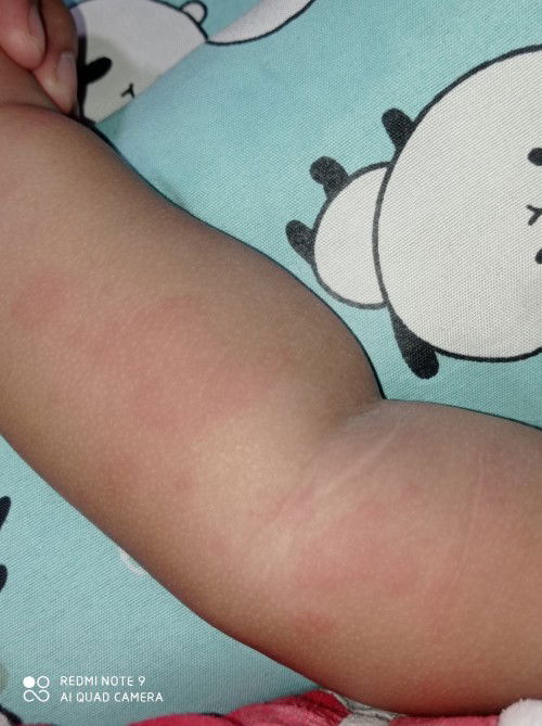 Biduran pada anak usia 5 bulan