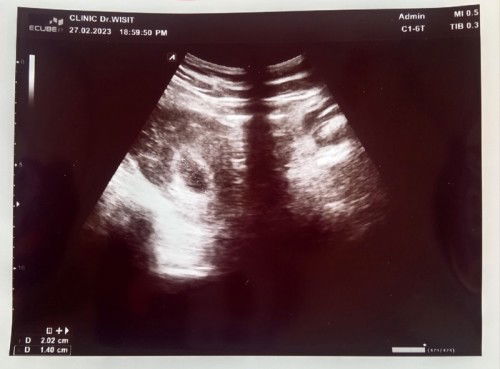 แท้งคุกคามเจอถุงตั้งครรภ์แต่ยังไม่เจอเด็ก