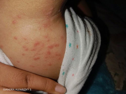 Alergi atau biang keringat